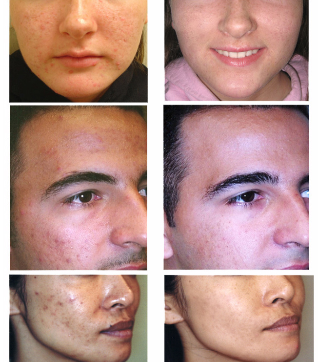 Images of before and after clearogen acne treatment