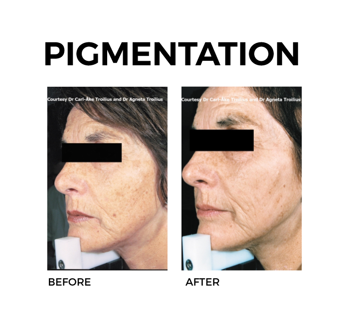 Ellipse Skin Rejuvenation for Pigmentation